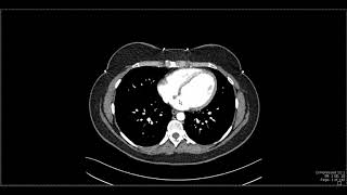 Abdominal Anatomy on Computed Tomography [upl. by Hametaf]