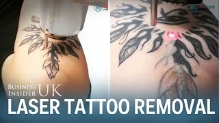 This is how laser tattoo removal works [upl. by Coffey]