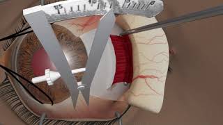 Strabismus surgery Resection [upl. by Meek]