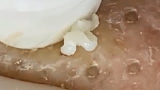 Deep blackhead extraction Cystic acne amp pimple popping 72 [upl. by Noeruat628]