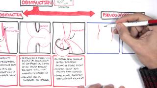 Bowel Obstruction  Causes and Pathophysiology [upl. by Demaria]