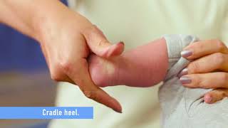 The importance of Bracing Clubfoot [upl. by Ittak]