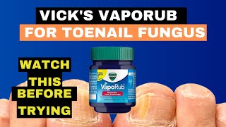 Vicks Vaporub for Nail Fungus  Toe Fungus Journey [upl. by Dmitri199]