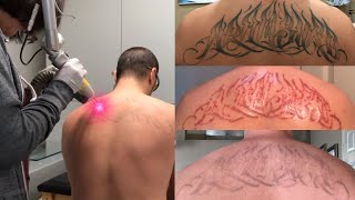 Laser Tattoo Removal  The Ugly Truth [upl. by Roanna]