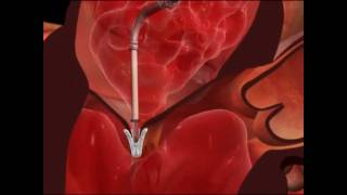 Mitral Valve Clip Repair ProcedureHow It Works [upl. by Unhsiv]