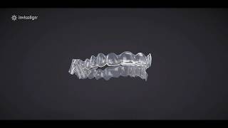 Invisalign Treatment With Mandibular Advancement [upl. by Eatnoj477]