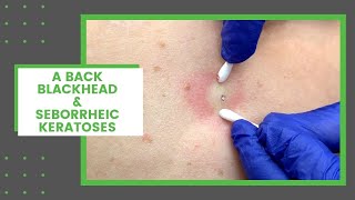 A Back Blackhead amp Seborrheic Keratoses  Dr Derm [upl. by Burch610]