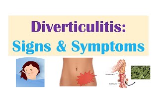 Diverticulitis Signs amp Symptoms And Why They Occur [upl. by Auqinal806]