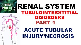 ACUTE TUBULAR INJURYNECROSIS or ACUTE KIDNEY INJURY  Pathology [upl. by Guevara307]