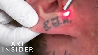 How Tattoo Removal Works [upl. by Salema]