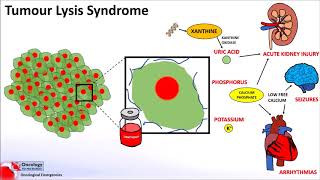 Tumour Lysis Syndrome [upl. by Ramled]