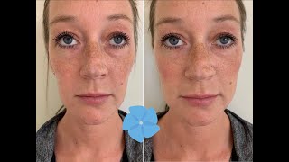 Juvederm Voluma Cheek Filler Treatment  Before  After  Nashville PA [upl. by Siouxie95]