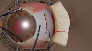 Strabismus surgery Recession [upl. by Melak127]