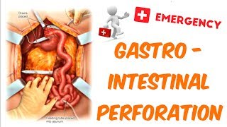 Gastrointestinal Perforation [upl. by Gnil862]