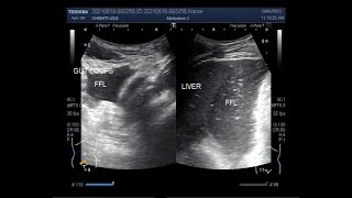 Intestinal Obstruction with perforation [upl. by Ahsiekin]