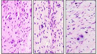 Neuroblastoma and Ganglioneuroma  Adventures in Neuropathology [upl. by Aidualk588]