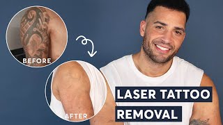 Laser Tattoo Removal  FULL ARM Tattoo Update after 3 treatments [upl. by Yelrac360]