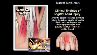 Sagittal Band Injury  Everything You Need To Know  Dr Nabil Ebraheim [upl. by Ferde]