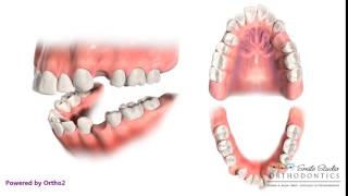 4 First Premolar Extraction for Retraction  Orthodontic Treatment [upl. by February687]