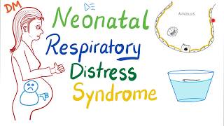 Neonatal Respiratory Distress Syndrome NRDS  Pediatrics  Pulmonology [upl. by Egarton719]