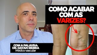 COMO ACABAR COM AS VARIZES Eu sou médico vascular você sabia  Dr Dayan Siebra varizes saude [upl. by Launce780]