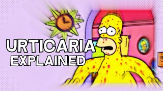 What is Urticaria Hives  EXPLAINED IN 3 MINUTES [upl. by Wooldridge]