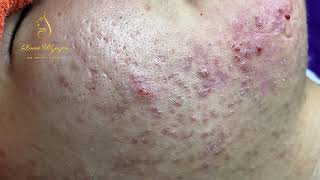 Blackheads Removal 333a  Loan Nguyen [upl. by Tedie]