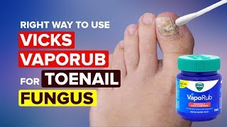 The Right Way To Use Vicks Vaporub for Toenail Fungus  Toenail Fungus Cure [upl. by Valonia]