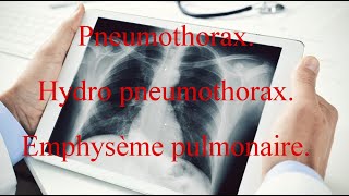 Pneumothorax  Hydro pneumothorax  Emphysème pulmonaire [upl. by Sam579]