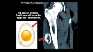 Myositis Ossificans  Everything You Need To Know  Dr Nabil Ebraheim [upl. by Neural]