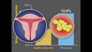 PostCesarean Infection and Antibiotic Prophylaxis  NEJM [upl. by Latisha]