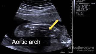 Basic Obstetric Ultrasound First Trimester Pregnancy [upl. by Engedi]