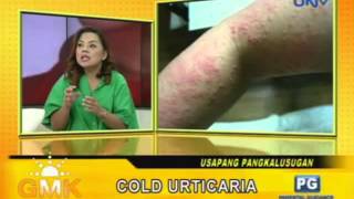 Cold Urticaria [upl. by Inaja]